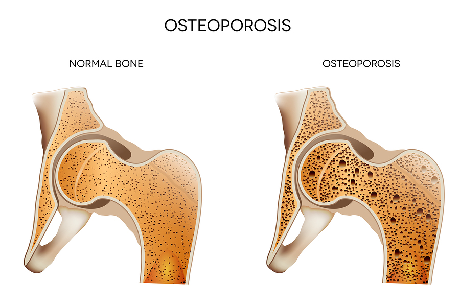 Homecare in Fairfax VA: Osteoporosis Facts